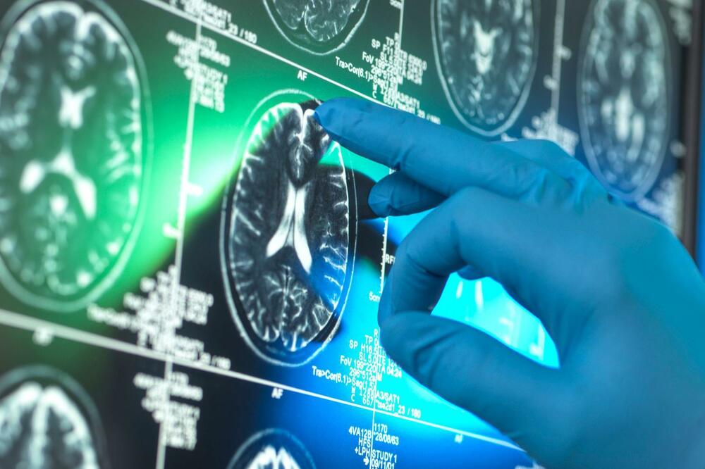 Analiza: "Inovativni" ljekovi protiv Alchajmera ne pomažu značajno