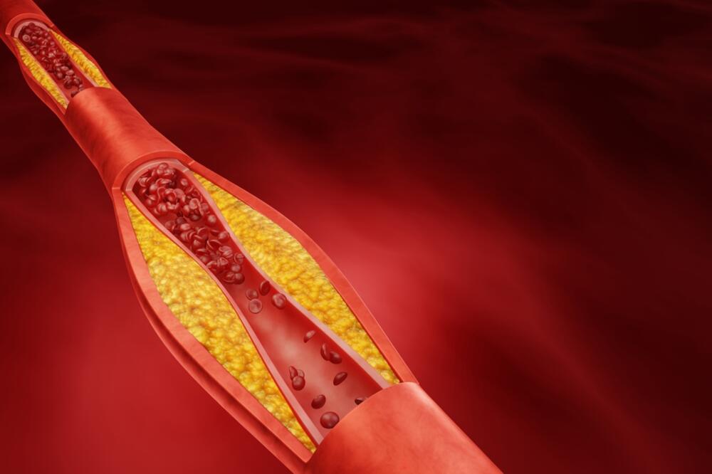 Šta je opasnije: Visoki trigliceridi ili holesterol?